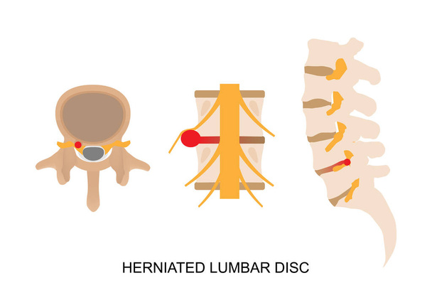 Illustrazione di ernia del disco lombare in vista diversa. - Vettoriali, immagini