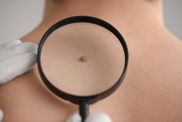 Dermatologist examining mole on young man's back with magnifier in clinic, closeup - Fotoğraf, Görsel