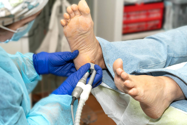 Podiatr používající lékařskou emery board k odstranění suché kůže z paty nohy pacienta. Kvalitní fotografie - Fotografie, Obrázek