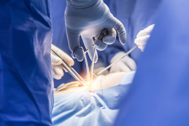 Kirurgi tai lääkäri sinisessä univormussa teki leikkauksen kirurgisessa sairaalassa oranssilla valovaikutuksella ja hämärtyneellä taustalla. Kirurgi ja sairaanhoitaja käyttävät leikkaussalissa lääketieteellistä instrumenttia tai välineistöä.. - Valokuva, kuva