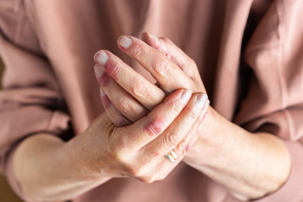 Close up of elder woman hands with atopic dermatitis, eczema, allergy reaction on dry skin - Fotó, kép