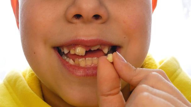 Uma criança segura um dente de leite recém-caído na frente da câmera. Mudança de dentes em crianças. Odontologia pediátrica. Dentes saudáveis em crianças. No fundo, uma criança sorridente sem um dente frontal - Foto, Imagem
