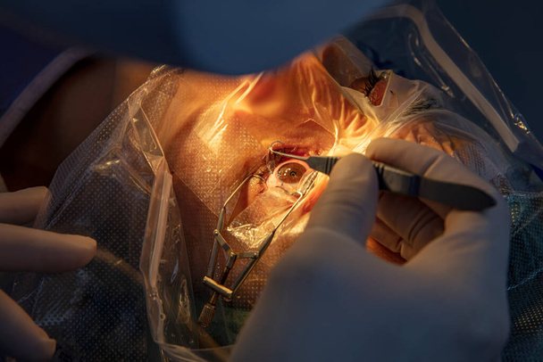 Lazer görüş düzeltmesi. Bir hasta ve bir cerrah ekibi göz ameliyatı sırasında ameliyathanede. Steril kapak altındaki hasta. Göz muayenesi için oftalmoloji ve görme için lazer düzeltmesi.. - Fotoğraf, Görsel