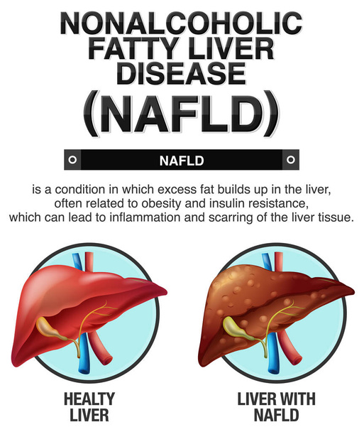 Ілюстрація неалкогольних жирових захворювань печінки
 - Вектор, зображення