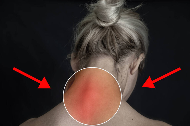 Het hoofd en de nek van een meisje met een gemarkeerde plaats op de nek in het rood waar de wervelkolom pijn, kromming van de cervicale wervelkolom in een meisje, geneeskunde - Foto, afbeelding