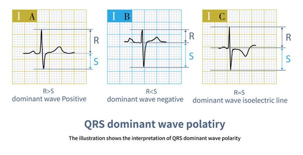 S dalgasından büyük R dalgası pozitif olarak değerlendirilir; S 'den küçük R dalgası negatif olarak değerlendirilir; S genliğine eşit R eklemsel olarak hesaplanır. - Fotoğraf, Görsel