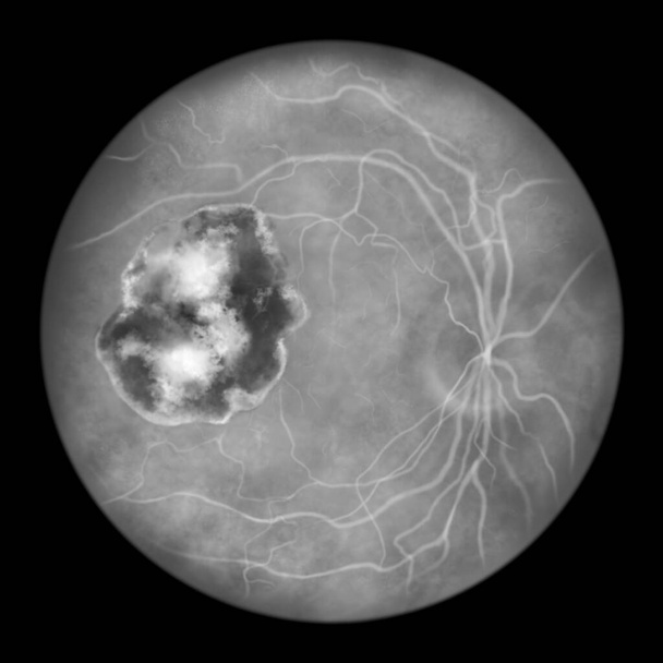 Jizva na sítnici v toxoplazmóze, onemocnění způsobené jednobuněčnou protozoan Toxoplasma gondii, vědecké ilustrace, fluorescein angiografie - Fotografie, Obrázek