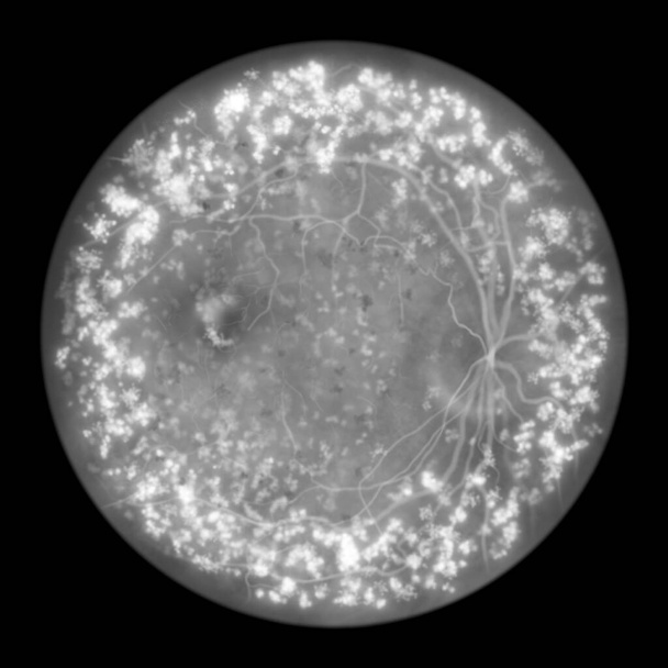 Аутосомно-доминантная витреоретинохороидопатия, редкое генетическое заболевание, иллюстрация гиперфлуоресцентных поражений, дефектов окон и утечки липофускина на флуоресцеиновой ангиограмме - Фото, изображение