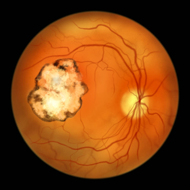 Cicatrice retinica in toxoplasmosi, una malattia causata dal protozoo monocellulare Toxoplasma gondii, vista oftalmoscopica, illustrazione scientifica - Foto, immagini