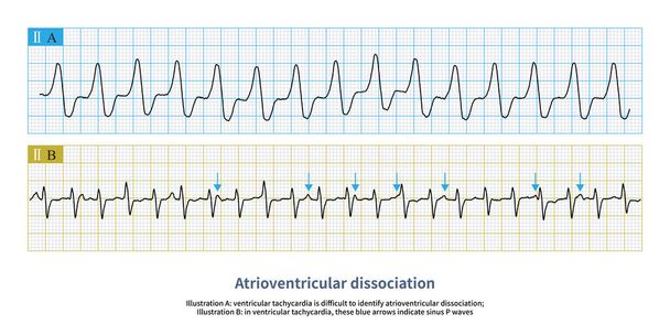 Атриовентрикулярная диссоциация является ключом к диагностике ВТ. Синяя стрелка показывает синусовую волну P, которая не связана с волной QRS. Диагноз желудочковой тахикардии ясен.. - Фото, изображение