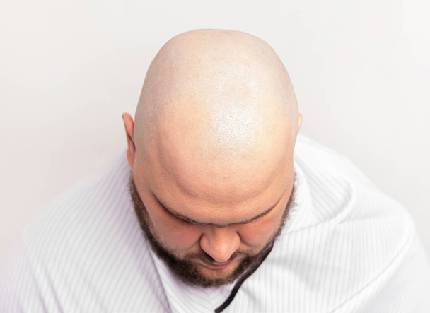 przed i po łysej głowie mężczyzny. łysa głowa mężczyzny, goląca się łysa w fryzjerze. - Zdjęcie, obraz