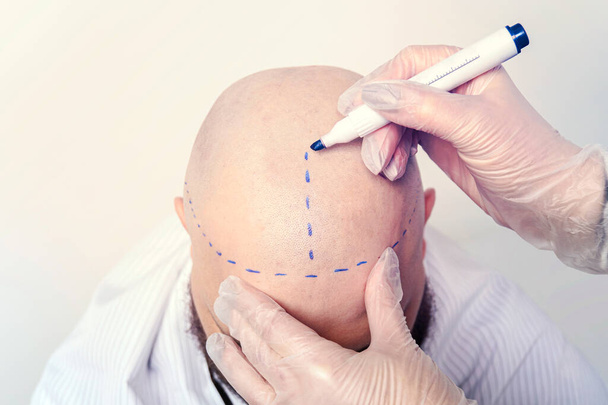 a nurse draws stripes on the bald skull of a young man for brain surgery. The concept of surgery and medicine.. the process of hair transplantation on the head. treatment of baldness. - Photo, Image