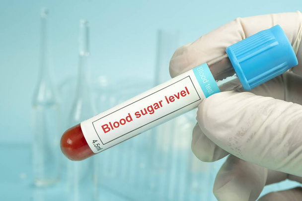 Laboratorní vzorek zkumavky glykované hemoglobin nebo hemoglobin A1C test HbA1C. Tato hladina cukru v krvi používaná k diagnostice Diabetes mellitus disease DM a kontrola glykemie u pacienta. Lékařský koncept - Fotografie, Obrázek
