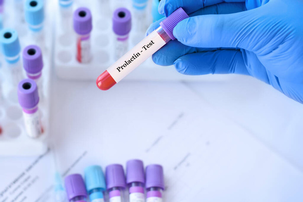 Arzt im Reagenzglas mit Prolaktin-Test auf dem Hintergrund medizinischer Reagenzgläser mit Analysen. - Foto, Bild