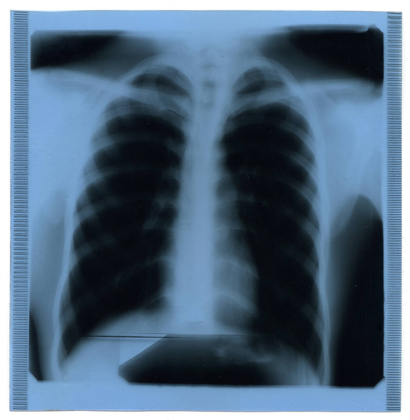 医療診断用の胸部X線スキャン - 写真・画像