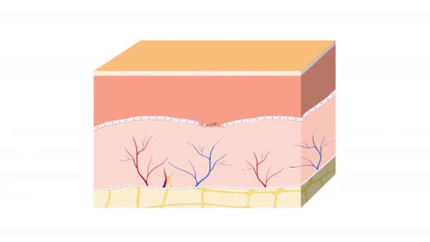 Рак кожи. Злокачественная базально-клеточная опухоль (начинается в базальных клетках). слои кожи человека и здоровый эпидермис - Кадры, видео