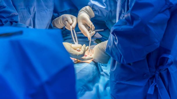 Médecin ou chirurgien a fait une opération de réparation de maille de hernie à l'intérieur de la salle d'opération à l'hôpital. Réparation ouverte de la hernie inguinale chez le patient de masse de l'aine.. - Photo, image