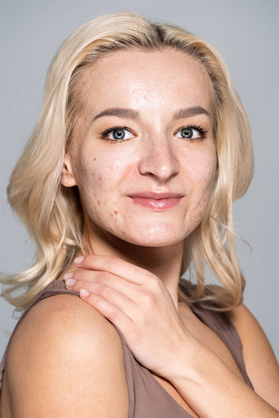 Portrait of smiling woman with acne on face touching shoulder isolated on grey  - Foto, imagen