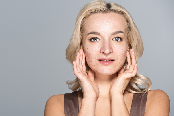 Blondýny žena s akné a problém kůže dotyková tvář izolované na šedé  - Fotografie, Obrázek