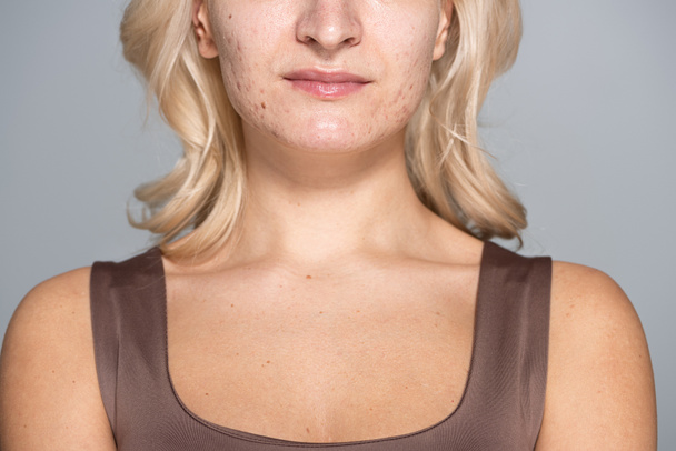 Ausgeschnittene Ansicht einer blonden Frau mit Problemhaut, die isoliert auf grau steht  - Foto, Bild