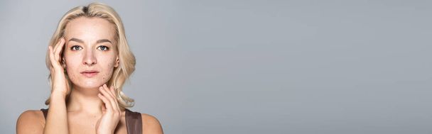 Blondýny žena s kožní problémy při pohledu na kameru izolované na šedé, banner  - Fotografie, Obrázek