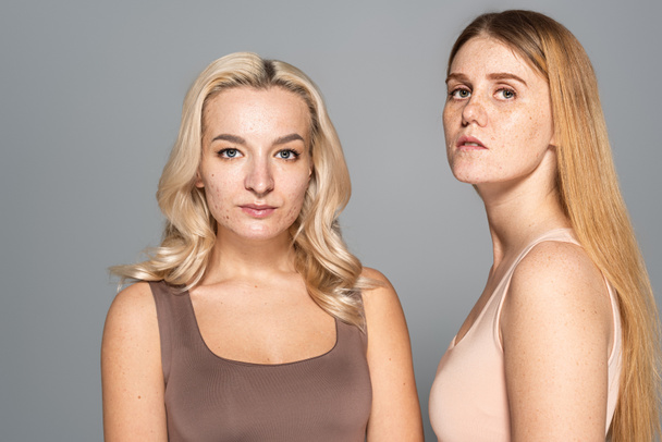 Models with skin issues looking at camera while standing isolated on grey  - Foto, Bild