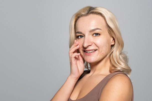 Mulher sorridente com acne na face tocando bochecha isolada no cinza  - Foto, Imagem