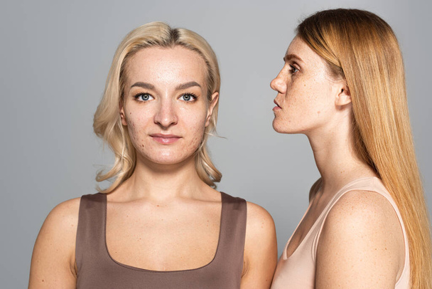 Portrét žen s akné a pihami na kůži izolované na šedé  - Fotografie, Obrázek