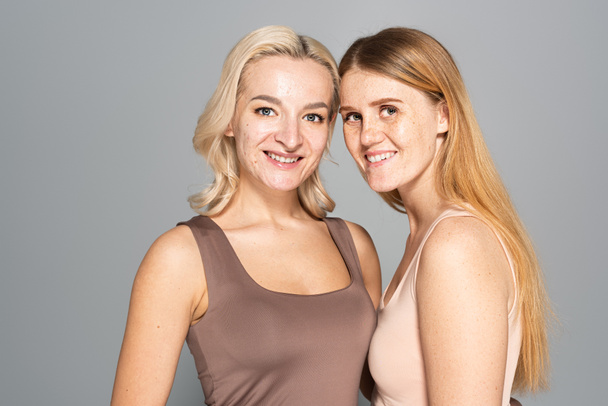 Щасливі друзі з проблемною шкірою стоять ізольовані на сірому
  - Фото, зображення