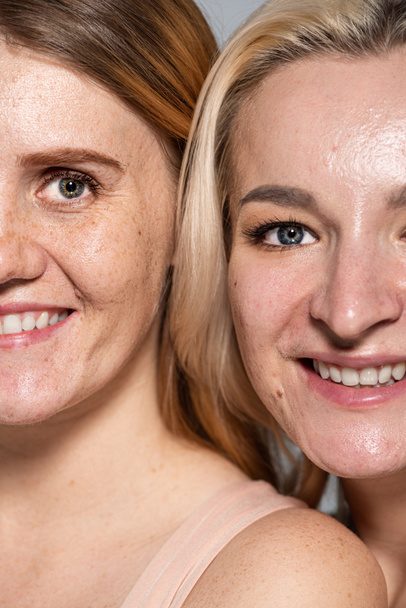 Vista recortada de mulheres sorridentes com problema de pele olhando para a câmera isolada em cinza  - Foto, Imagem