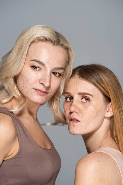 Portrait of freckled woman looking at camera near friend with acne isolated on grey  - Photo, Image