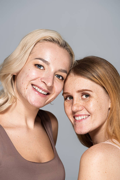 Šťastní přátelé s problémem kůže při pohledu na fotoaparát při úsměvu izolované na šedé  - Fotografie, Obrázek