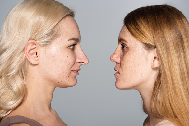 Side view of models with problem skin looking at each other while standing face to face isolated on grey  - Foto, Imagem