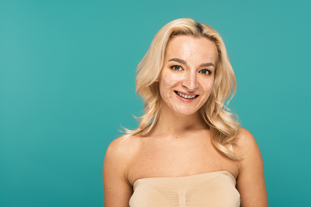 Portret van glimlachende blonde vrouw met acne kijken naar camera geïsoleerd op turquoise - Foto, afbeelding