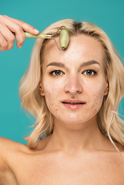 close up of blonde woman with acne lifting face with jade roller isolated on turquoise - Fotografie, Obrázek