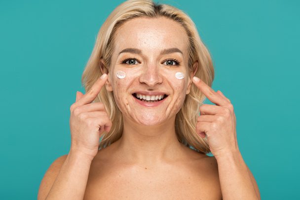 mujer alegre con acné aplicando crema y señalando con los dedos en la cara aislado en turquesa  - Foto, imagen