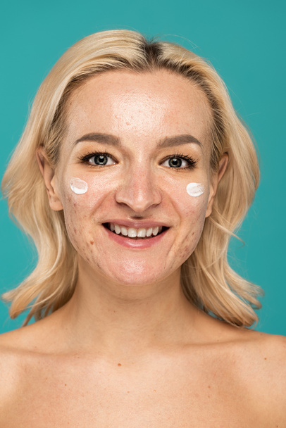 happy woman with skin issues applying treatment cream on face isolated on turquoise  - Fotografie, Obrázek