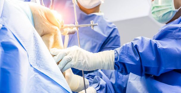 Osteomi sırasında ameliyat odasındaki mavi elbiseli doktor veya cerrahın eli. İnsanlar ortopedi bölümündeki diz eklemi ameliyatında protez eklem plastiği taktılar. - Fotoğraf, Görsel