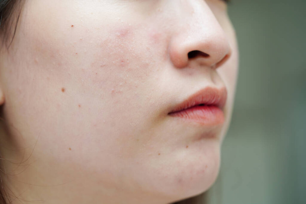Acne puistje en litteken op het gezicht van de huid, aandoeningen van talgklieren, tiener meisje huidverzorging schoonheidsprobleem. - Foto, afbeelding