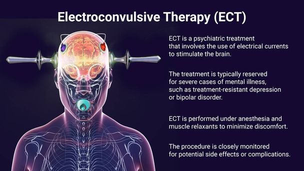 Elektrokonvülsif terapi, elektrokonvülsif terapi, beyin uyarılması için elektrik akımlarının kullanıldığı ağır akıl hastalıkları için kullanılan bir tedavi, 3 boyutlu illüstrasyon. - Fotoğraf, Görsel