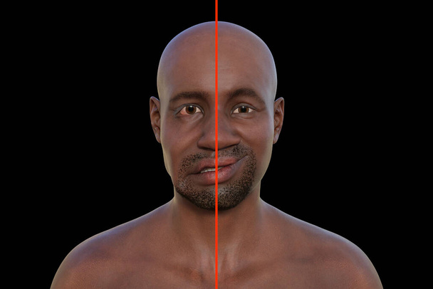 Porażenie twarzy u Afrykanina, fotorealistyczna ilustracja 3D podkreślająca asymetrię i opadanie mięśni twarzy po jednej stronie twarzy - Zdjęcie, obraz