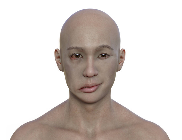 Bir erkekte yüz felci, fotorealistik üç boyutlu illüstrasyon yüz kaslarının bir tarafındaki asimetri ve düşüşü vurguluyor. - Fotoğraf, Görsel