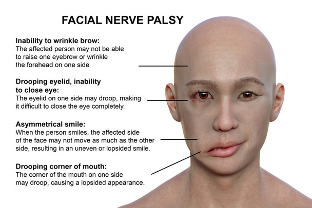 Porażenie twarzy u mężczyzny, fotorealistyczna ilustracja 3D podkreślająca asymetrię i opadanie mięśni twarzy po jednej stronie twarzy - Zdjęcie, obraz