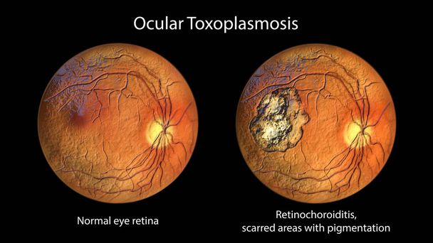 Retinale Narbe bei der Toxoplasmose, einer Krankheit, die durch die einzelligen Protozoen Toxoplasma gondii verursacht wird, und dieselbe gesunde Netzhaut des Auges zum Vergleich, Ophthalmoskop-Ansicht, 3D-Illustration - Foto, Bild
