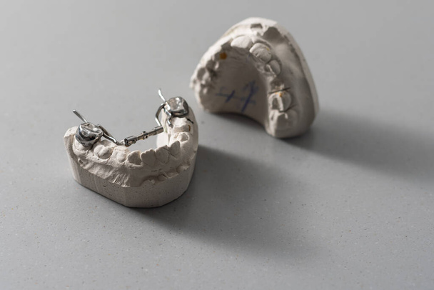 Modello di gesso di fusione dentale delle mascelle umane. Denti storti e morso distale. Gli spari sono stati fatti prima di trattamento con bretelle. Colpi tecnici su sfondo grigio. - Foto, immagini