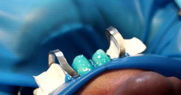 Hammaslääkäri soveltaa sininen geeli hampaan ennen asentamista laminaatit lähikuva. Laadukkaat hammaspinnoitteet - Materiaali, video