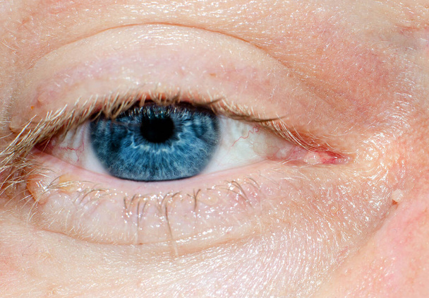 Papillomavirus göz kapağında - Fotoğraf, Görsel