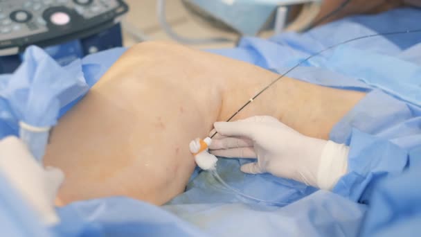 Chirurgové operují na nohou starší ženy s křečovými žilami. Pracovní proces chirurgů - Záběry, video
