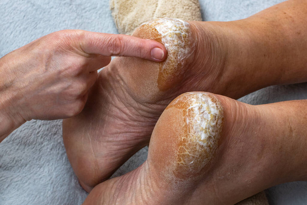 医者は保湿クリームで足のかかとの割れ乾燥肌を汚れます。痛いヒールにクリームを適用するのクローズアップ.足の皮膚治療の概念. - 写真・画像
