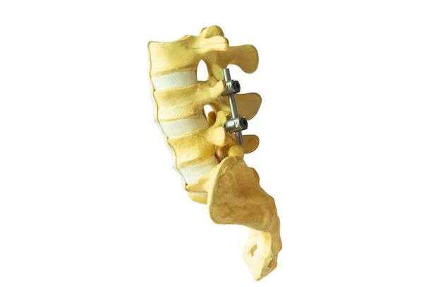 Vista laterale modello di colonna vertebrale lombare con asta e vite strumento di fissaggio isolato su sfondo bianco. - Foto, immagini